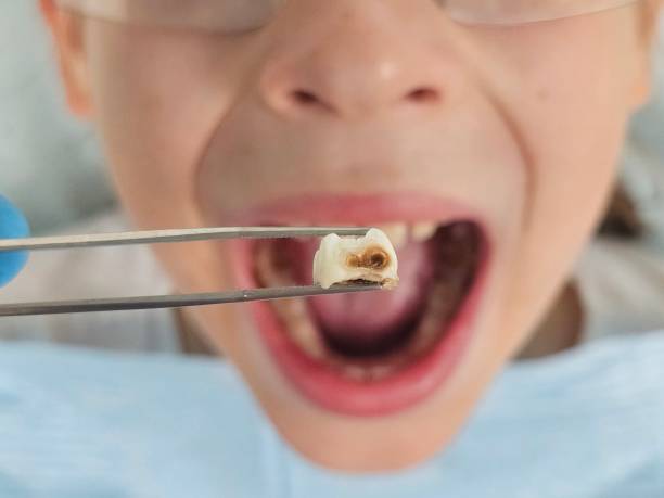 Best Emergency Tooth Extraction in Windsor Heights, IA